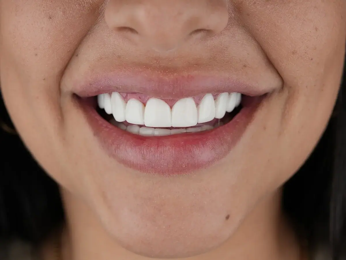 Después de carillas de resina — caso real de Smile Dental Center