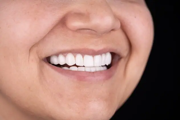 Paciente sonriendo después de su diseño de sonrisa