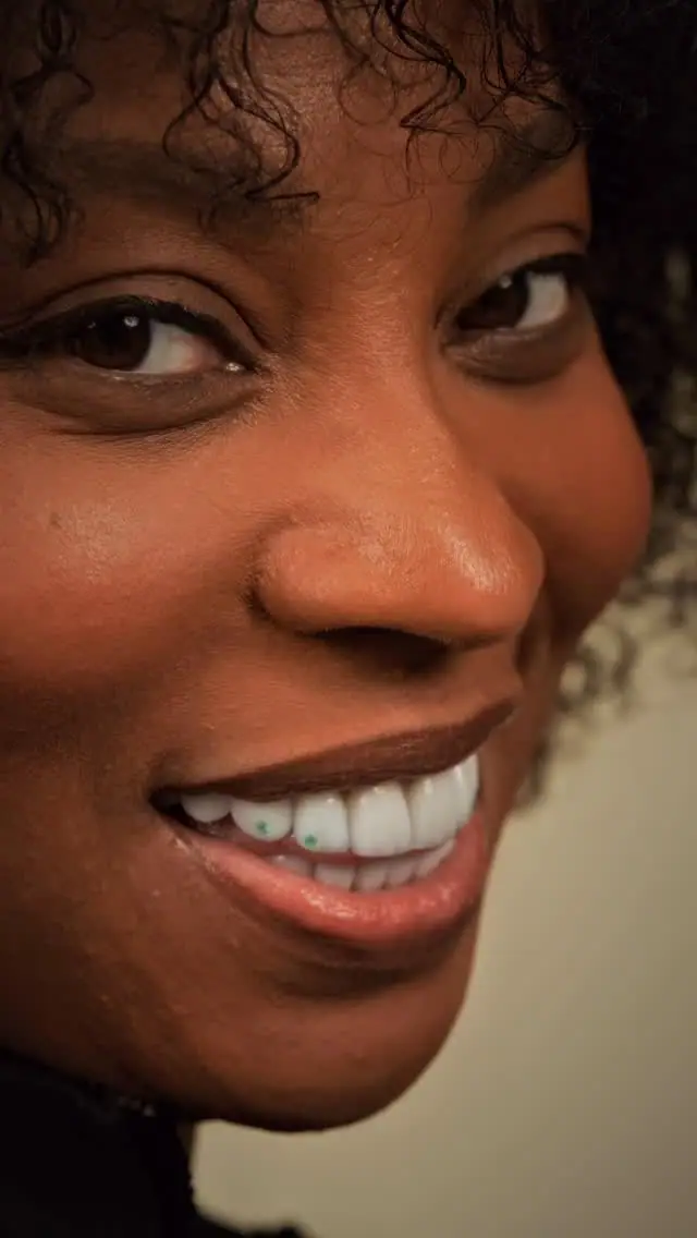 Resultado de carillas de porcelana en Instagram — Smile Dental Center