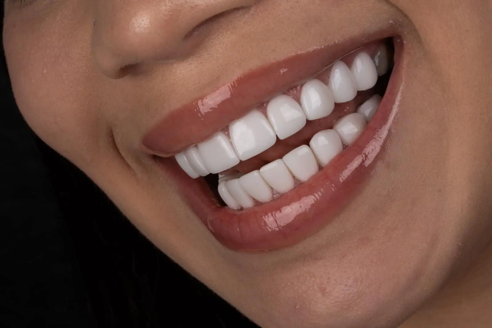 Transformación con carillas de resina — Smile Dental Center