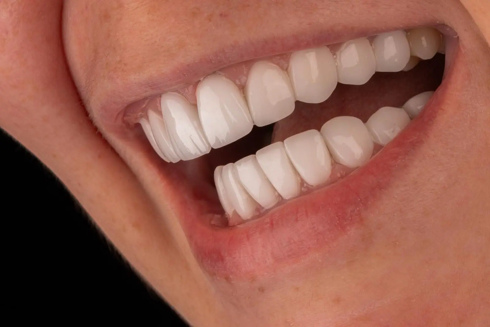 Sonrisa con carillas de porcelana — Smile Dental Center